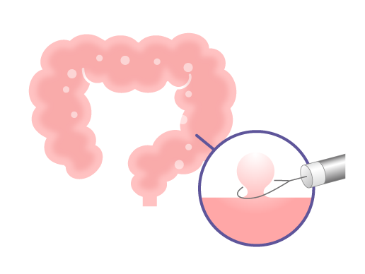 日帰り大腸ポリープ切除