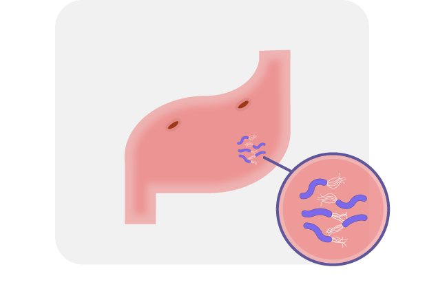 胃炎・胃十二指腸潰瘍・ピロリ菌感染
